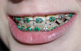 Braces mouthguard