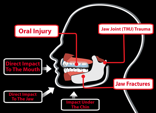Why Mouth Guards Are Recommended to Protect Your Teeth - Hemet