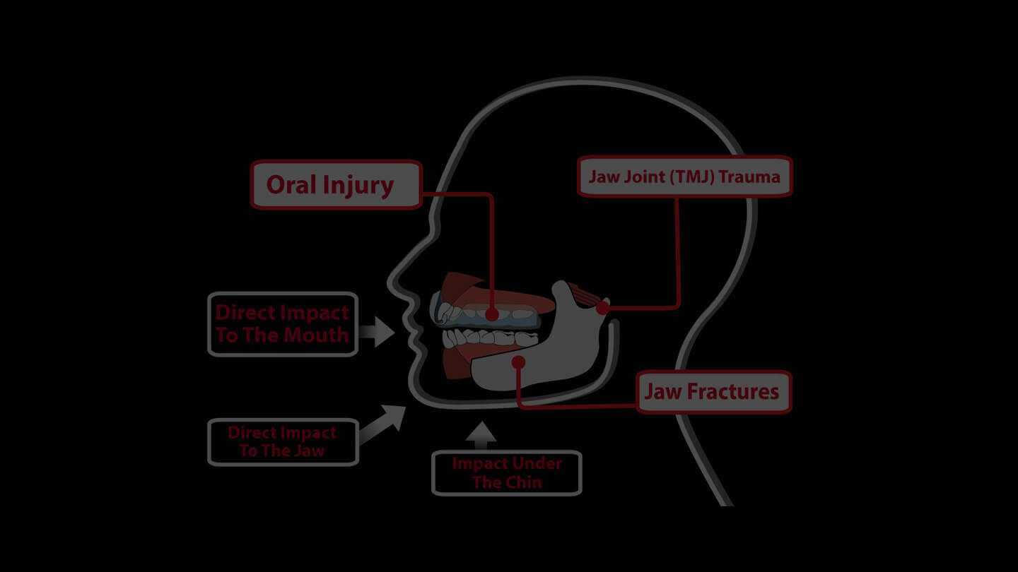 How Mouthguards Protect Athletes Gladiator Custom Mouthguards