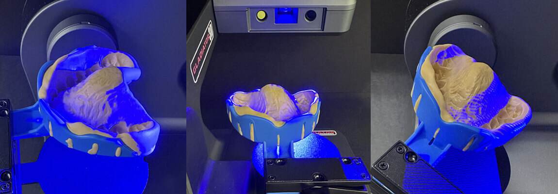 custom mouthguard 3d dental scan